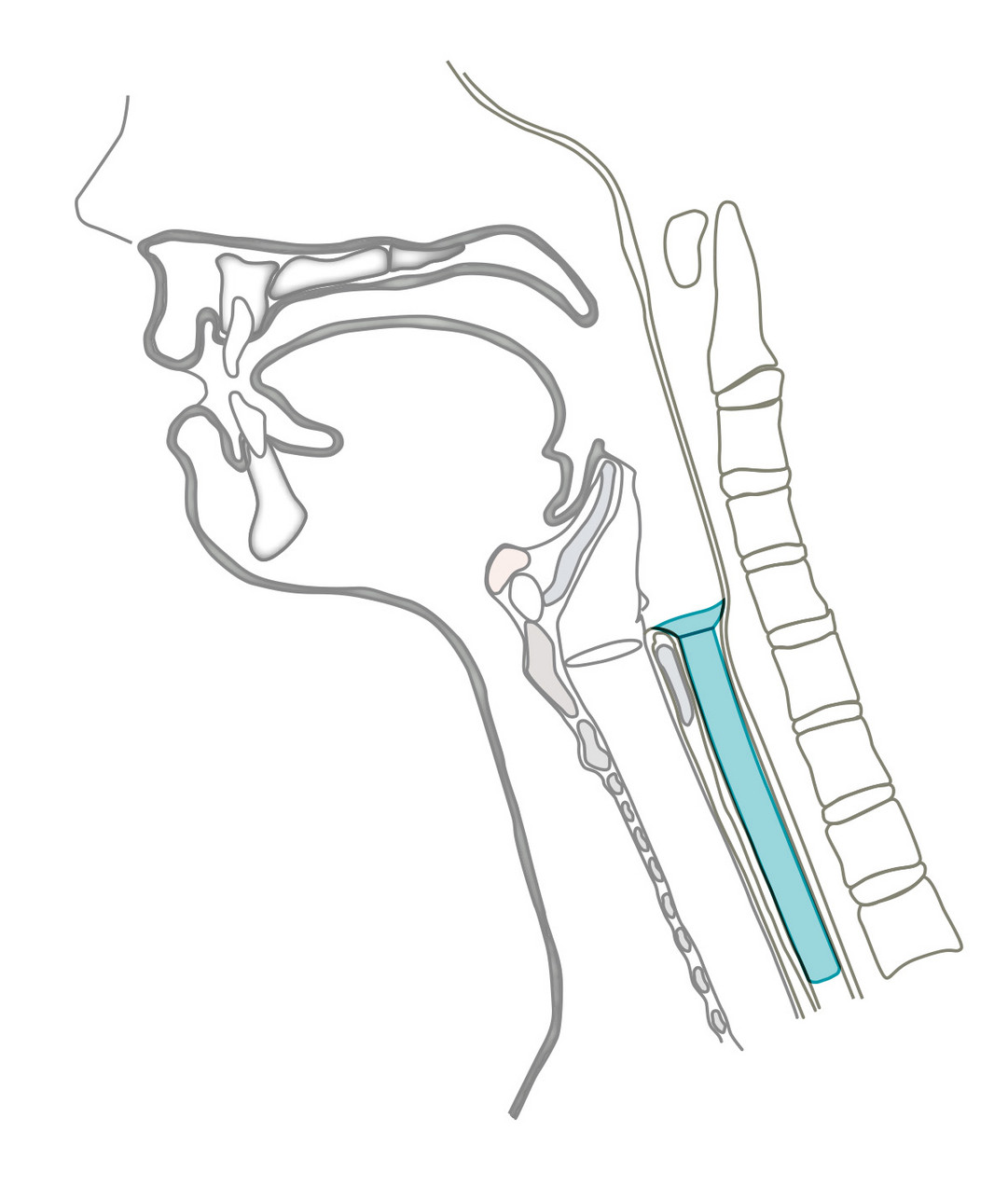 Montgomery® Salivary Bypass Tube