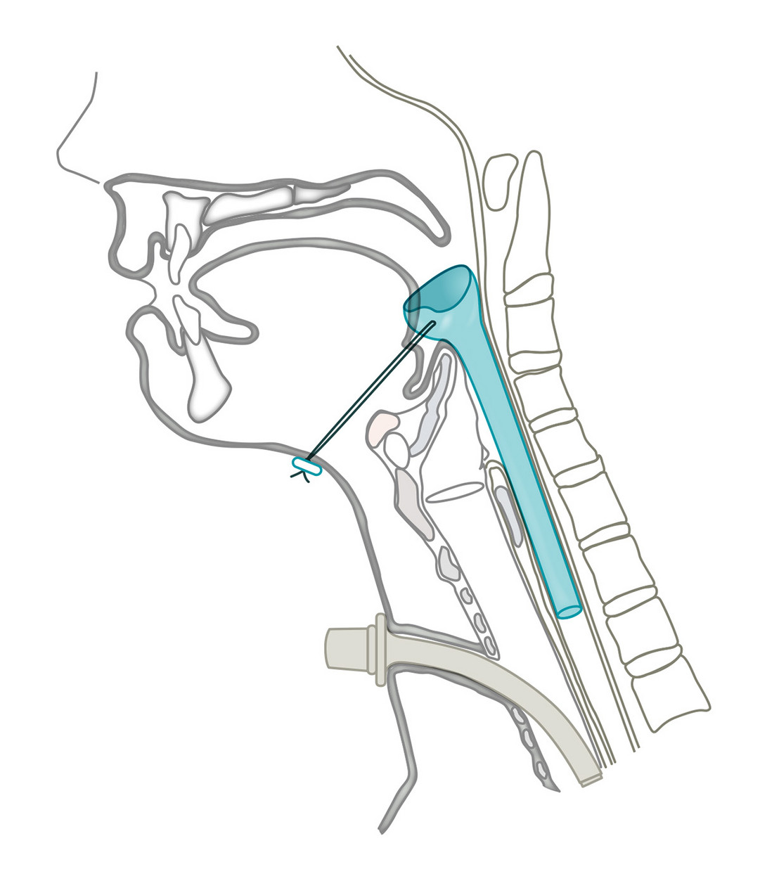 Har-El Pharyngeal Tube