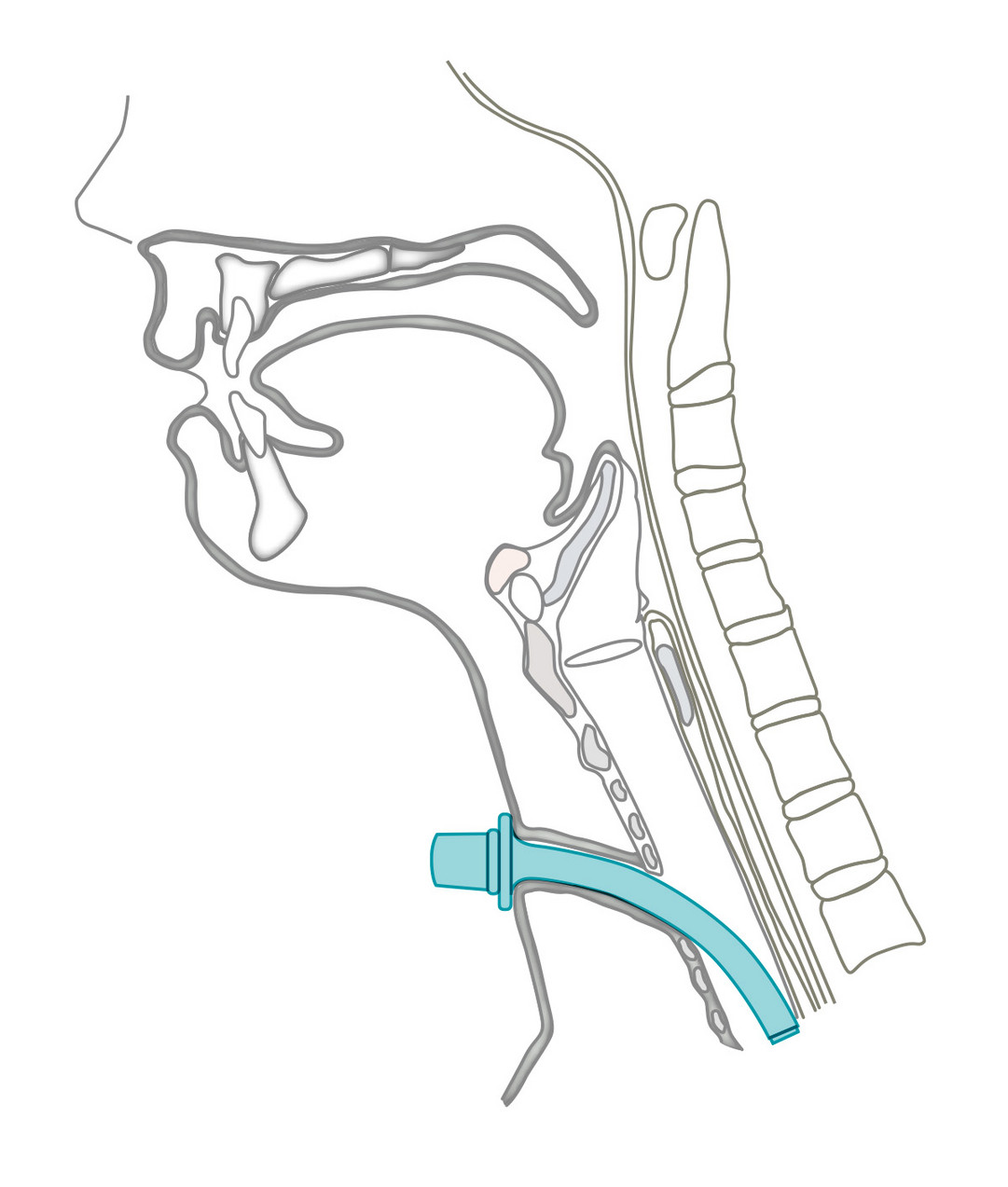 Moore Tracheostomy Tube