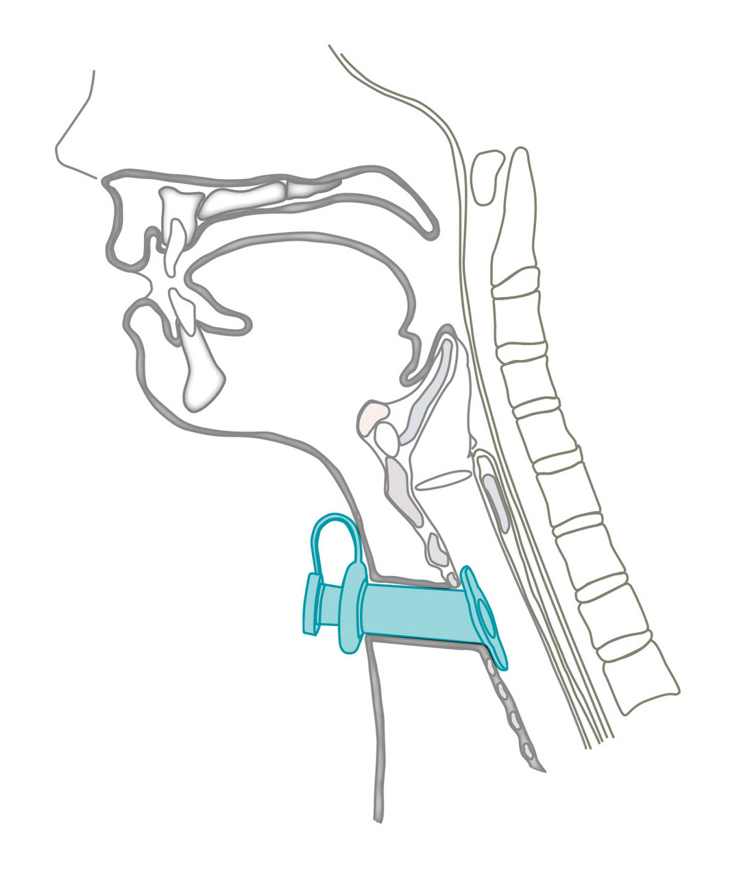 Montgomery® Long-Term Cannula